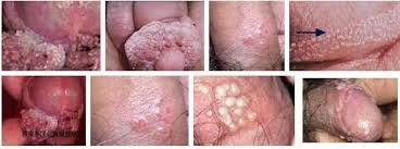 Illustration for article titled obat herpes manjur